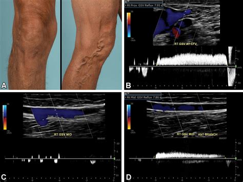 varicose veins ultrasound